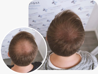 Haarpigmentierung Vorher Nachher Bilder von Patienten