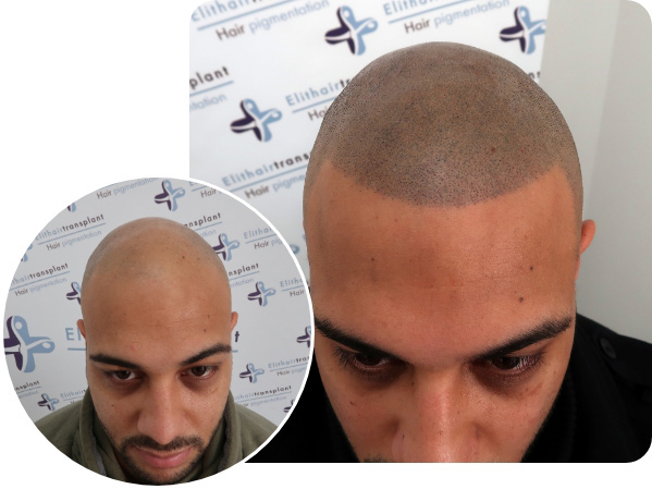 Der direkte Vorher Nachher Vergleich nach der Haarpigmentierung bei einem Patienten