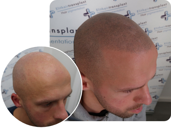 Vorher Nachher Bilder eines männlichen Patienten bei der Haarpigmentierung in Wien