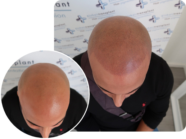 Elithair Kunde Vorher Nachher Vergleich bei der Haarpigmentierung Kurzhaarschnitt