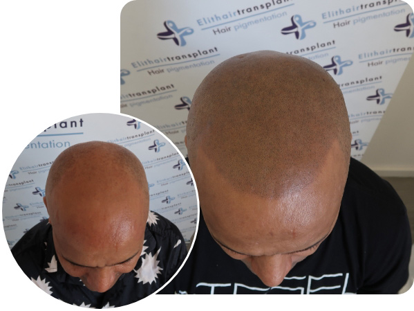 Mann Vorher Nachher Vergleich bei der Kurzhaarschnitt Haarpigmentierung 2
