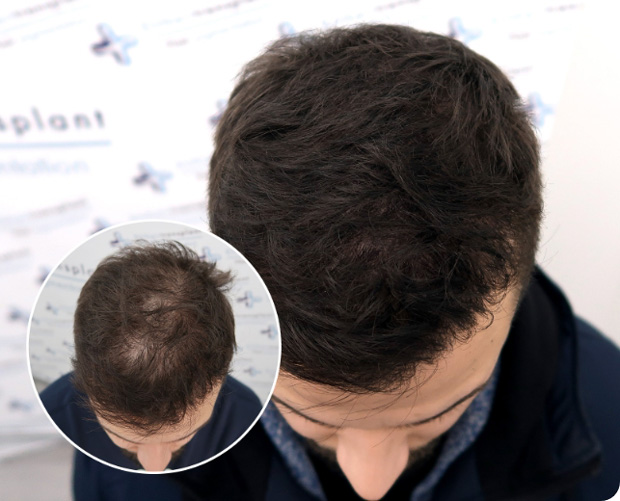 Mann Vorher Nachher Vergleich bei der Haarpigmentierung bei Elithair
