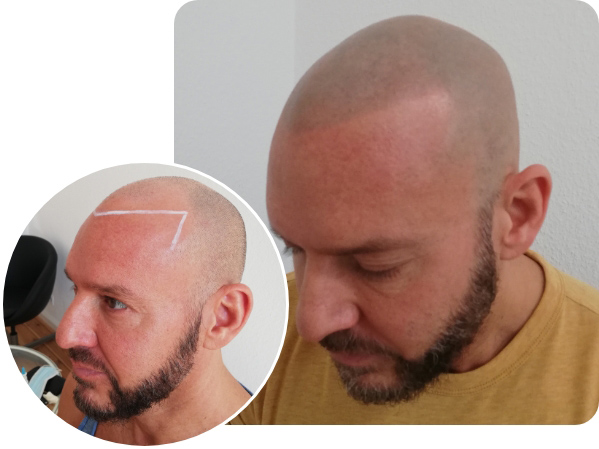 Mann Vorher Nachher Vergleich bei der Haarpigmentierung Kurzhaarschnitt von der Seite