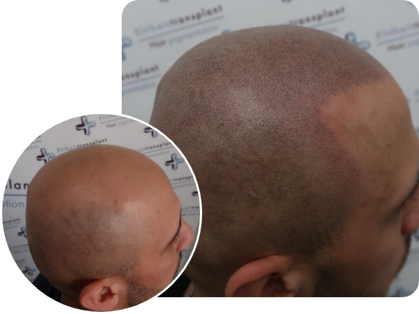 Mann Vorher Nachher Vergleich bei der Haarpigmentierung Kurzhaarschnitt von der Seite 2