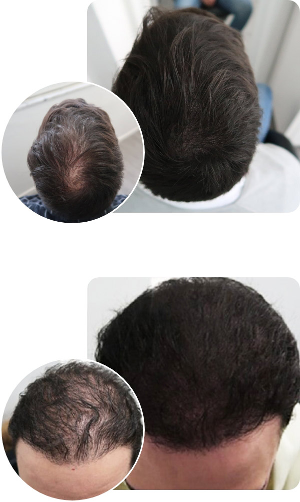 Haarpigmentierung Vorher Nachher Ergebnis bei zwei Patienten