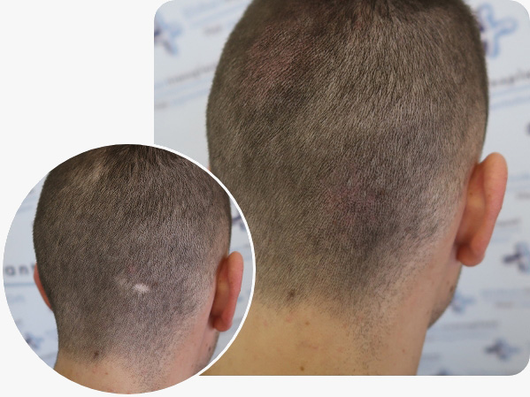 Vorher Nachher Bildervergleich bei einem Haarpigmentierung Patienten