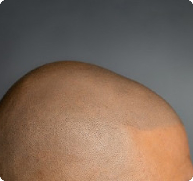 Seitliche Aufnahme des Kopfes eines Patienten nach der Nano Haarpigmentierung