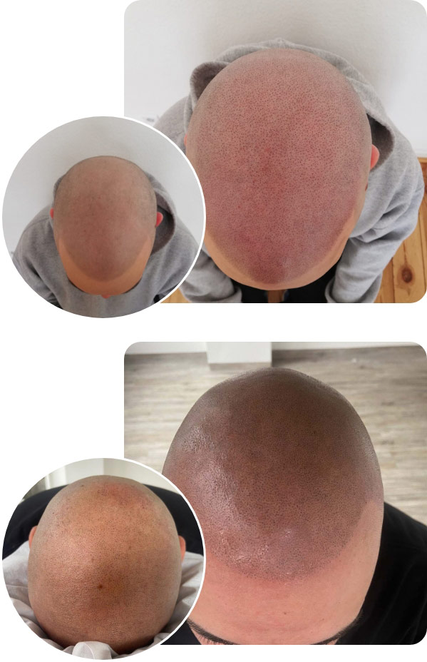 Direkter Vorher Nachher Vergleich zweier Patienten bei der Haarpigmentierung Auffrischung