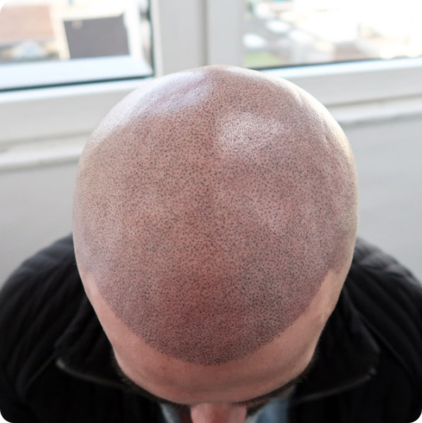 Patient nach der Haarpigmentierung zeigt seinen Kopf von oben