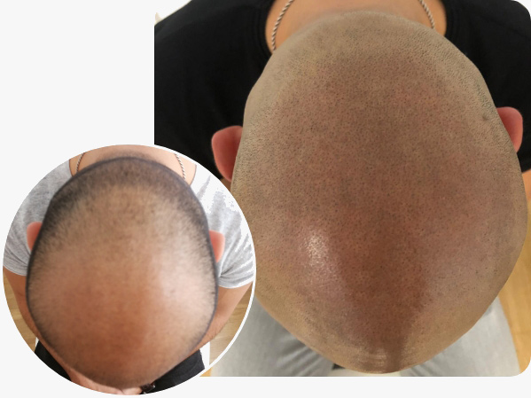 Vorher Nachher Bilder bei der Haarpigmentierung von Patienten mit Alopecia Totalis