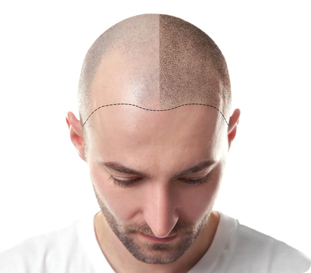 Direkter Vorher Nachher Vergleich beim männlichen Patienten nach Haarpigmentierung