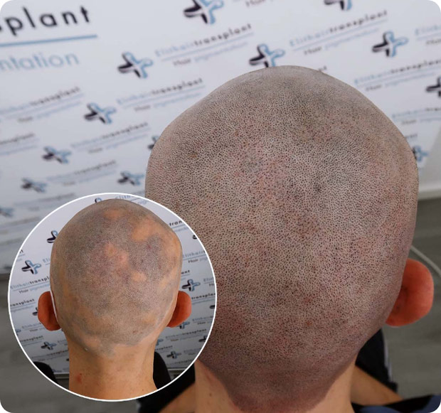 Vorher Nachher Bilder von Patienten mit Alopecia bei der Haarpigmentierung