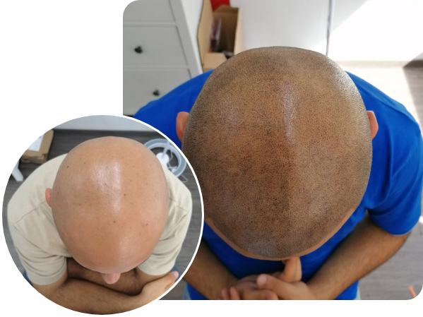 Vorher Nachher Vergleich bei Haarpigmentierung von Patienten mit Alopecia Universalis